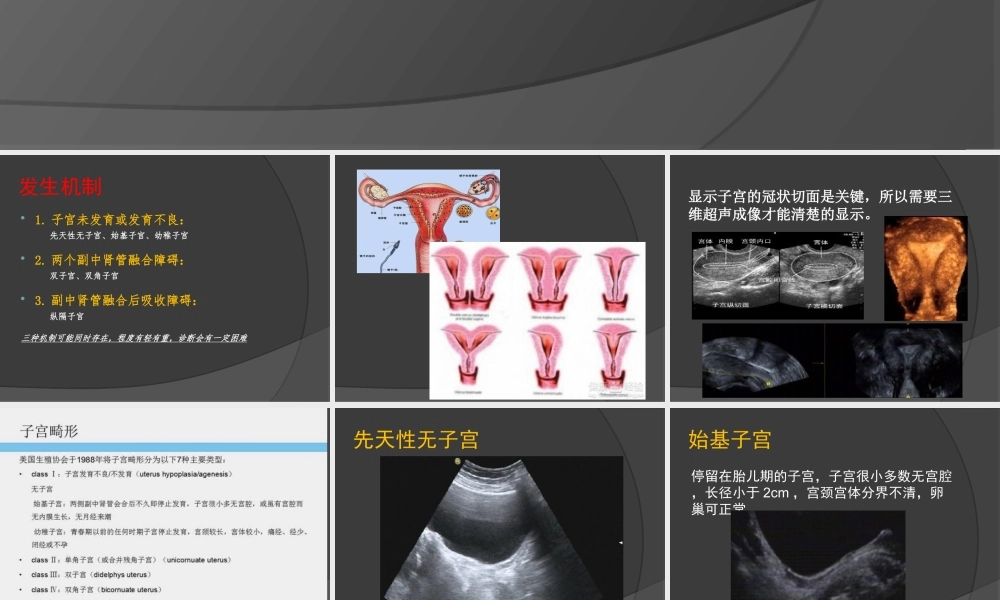 子宫畸形及三维成像.ppt