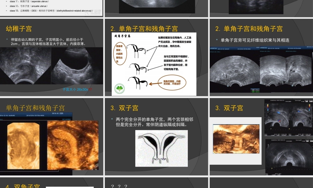 子宫畸形及三维成像.ppt
