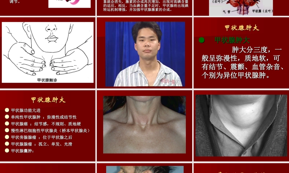 单纯性甲状腺肿PPT.ppt