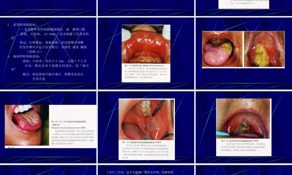 口腔溃疡[1].ppt.ppt