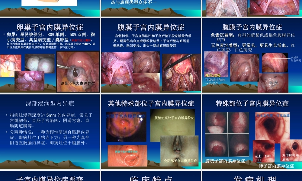 子宫内膜异位症(1).ppt