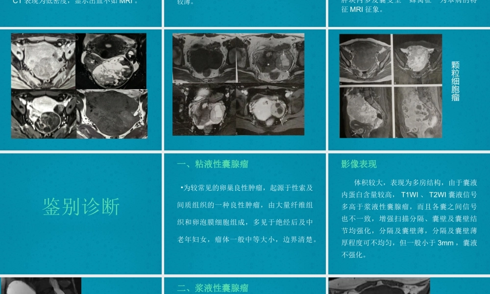 卵巢颗粒细胞瘤.pptx