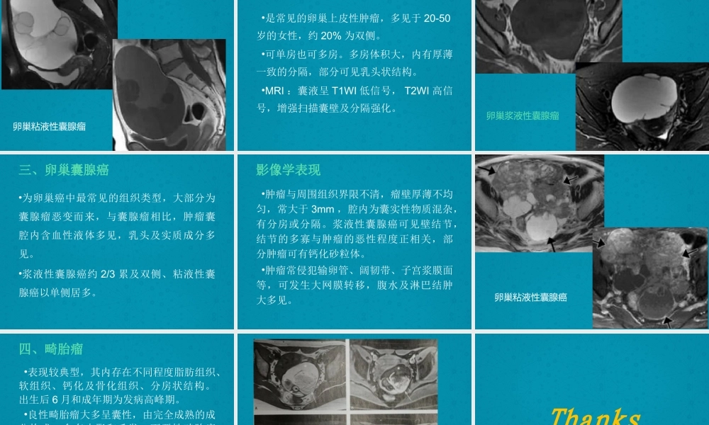 卵巢颗粒细胞瘤.pptx