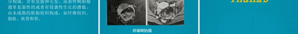 卵巢颗粒细胞瘤.pptx