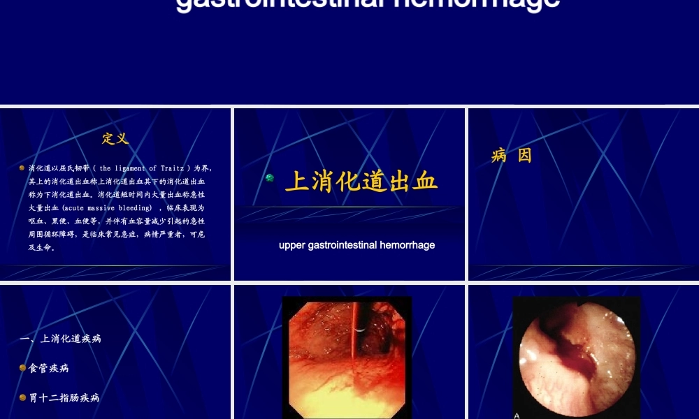 其上的消化道出血称上消化道出血其下的消化道出血称为下消化道出血.ppt