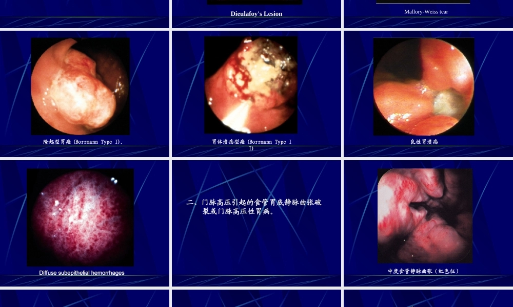 其上的消化道出血称上消化道出血其下的消化道出血称为下消化道出血.ppt