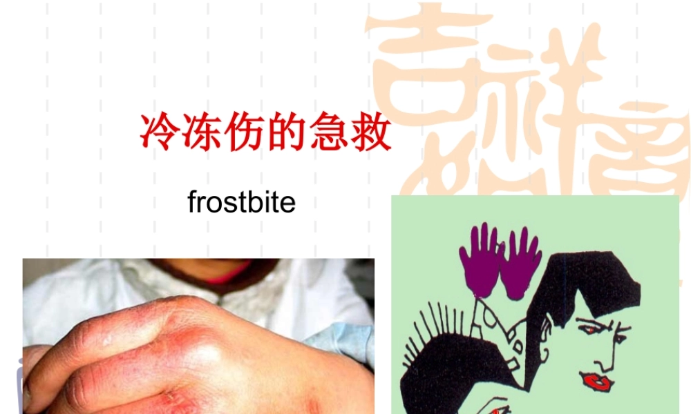 冻伤急救.ppt
