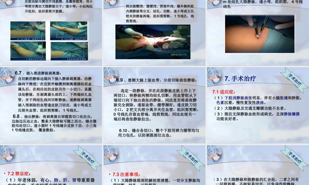 大隐静脉剥脱术.ppt