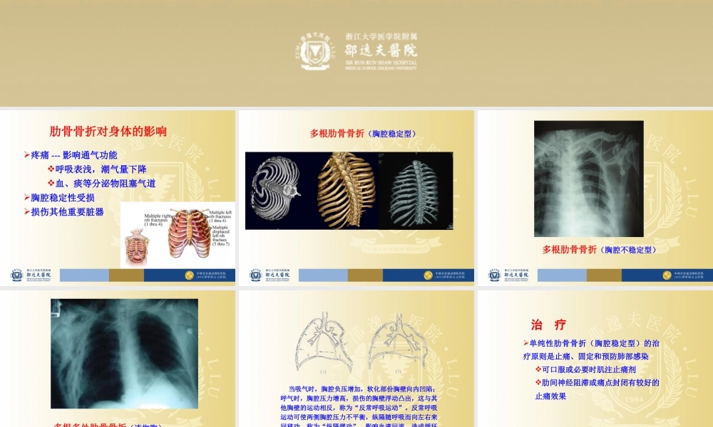 多根肋骨骨折胸腔不稳定型.ppt