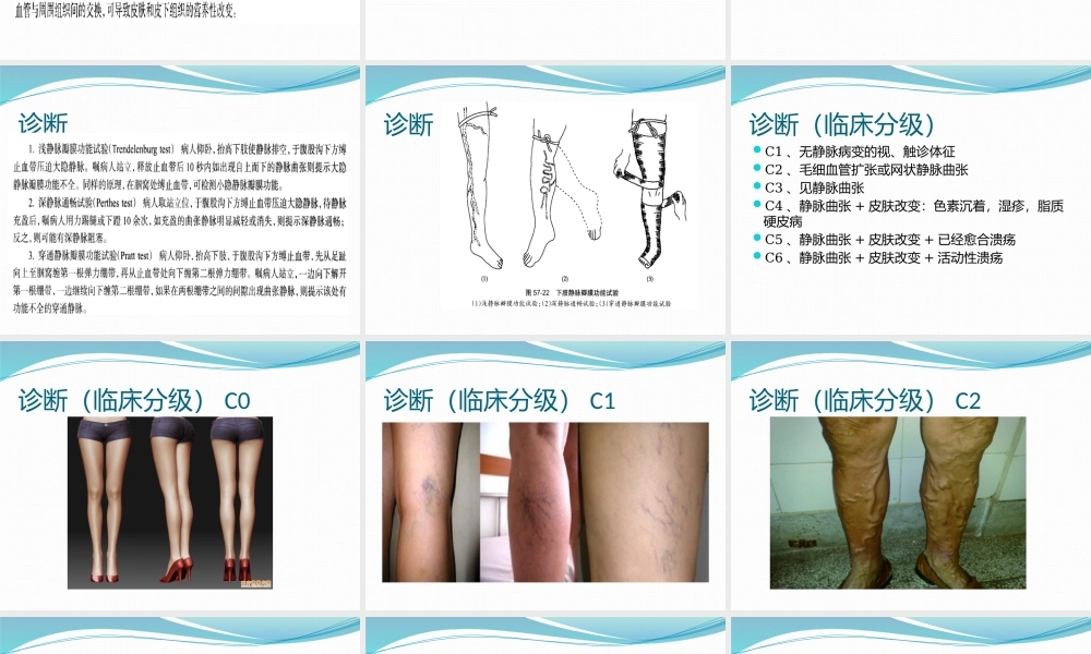 单纯性下肢静脉曲张.pptx