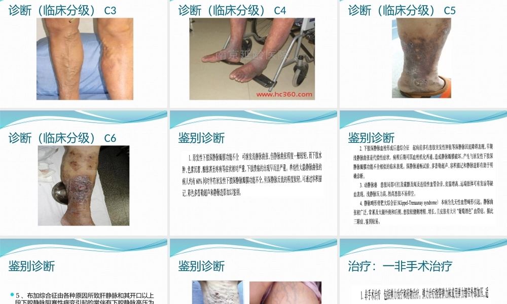 单纯性下肢静脉曲张.pptx