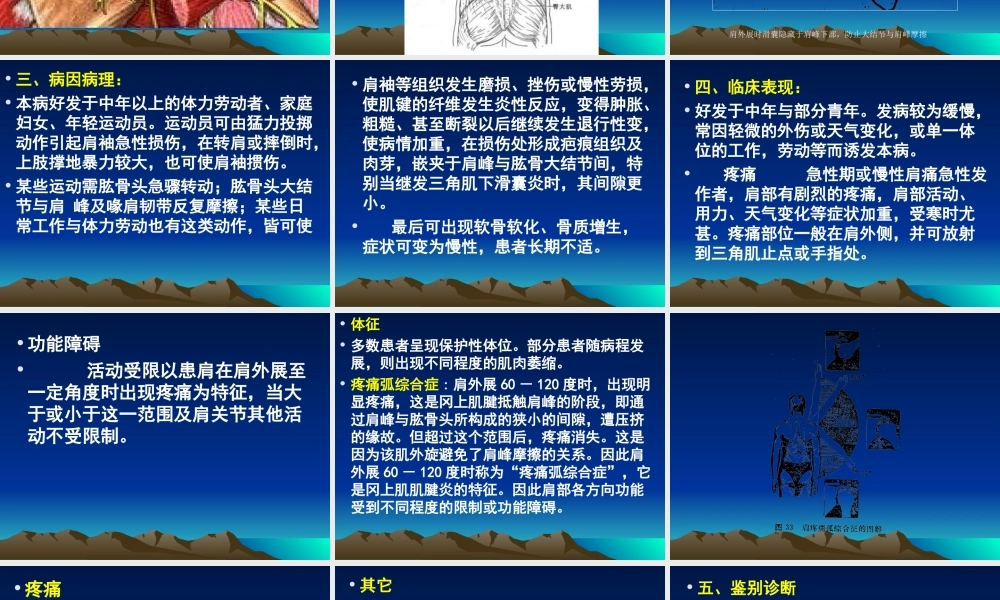 冈上肌肌腱炎.ppt