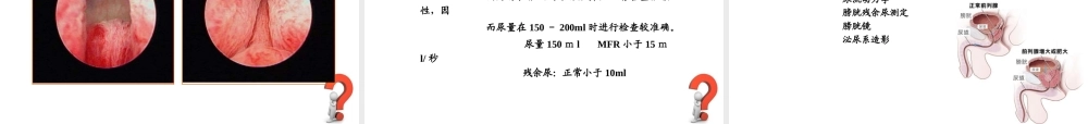前列腺增生症.PPT.ppt