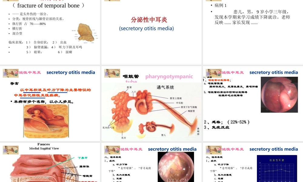 分泌性中耳炎-大连医科大学附属第二医院.ppt