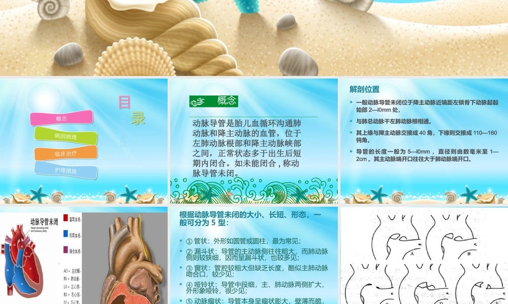 动脉导管未闭9.ppt