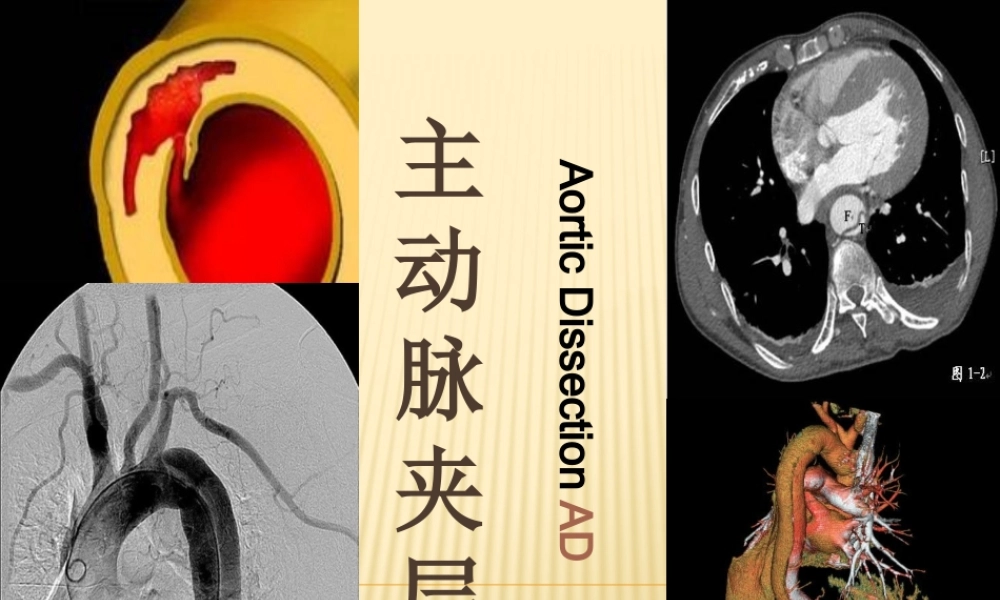 主动脉夹层-ppt.pptx