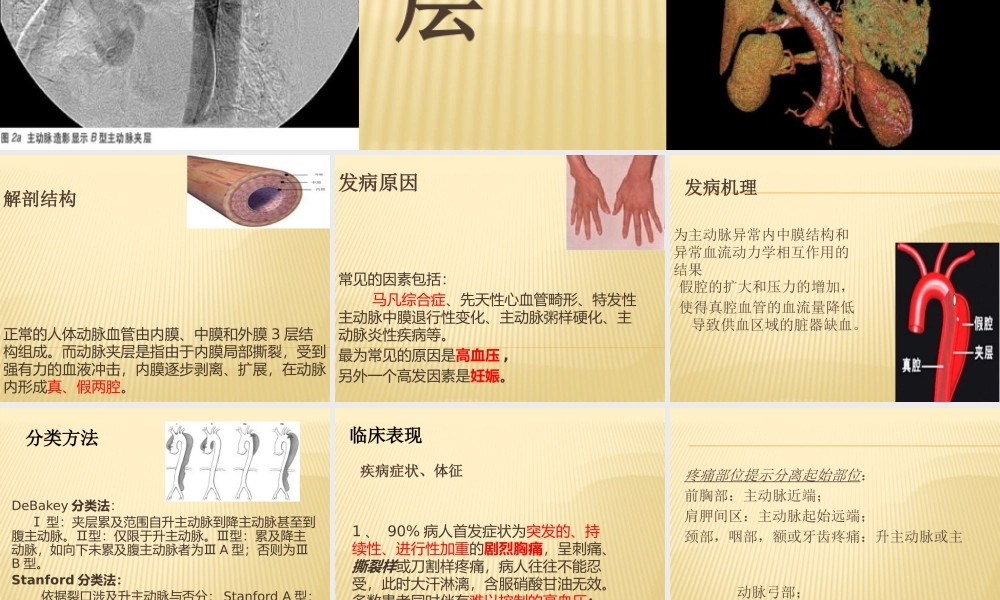 主动脉夹层-ppt.pptx