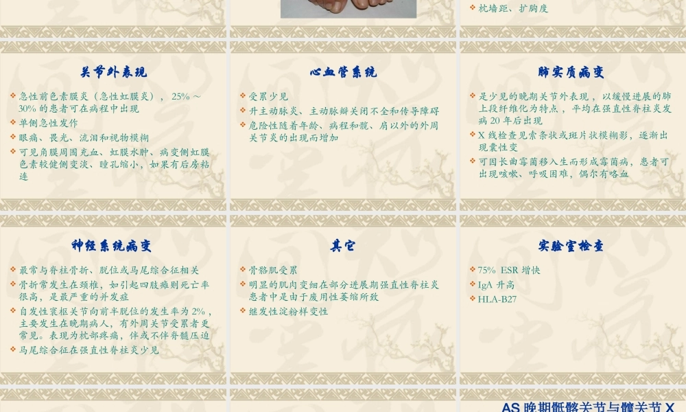 中西医结合骨伤-强直性脊柱炎.ppt