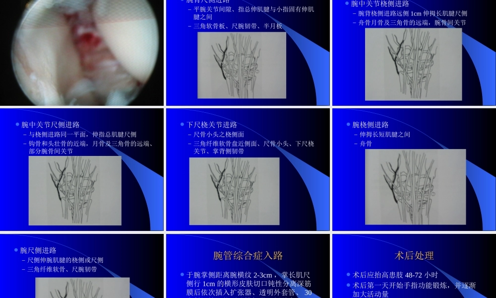 内窥镜在手外科的应用.ppt