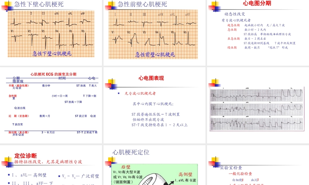 冠心病急性心肌梗死.ppt