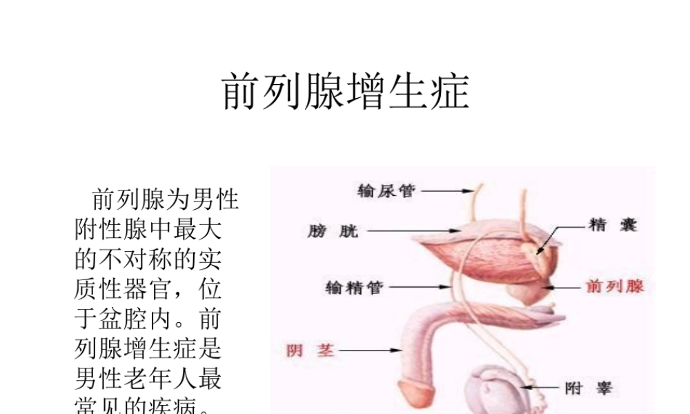 前列腺增生症.ppt