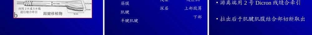 关节镜下的后交叉韧带重建术.ppt