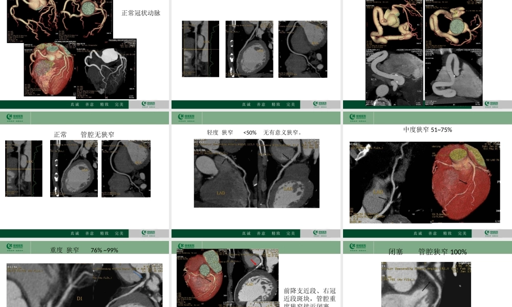 冠心病的CT检查价值.ppt