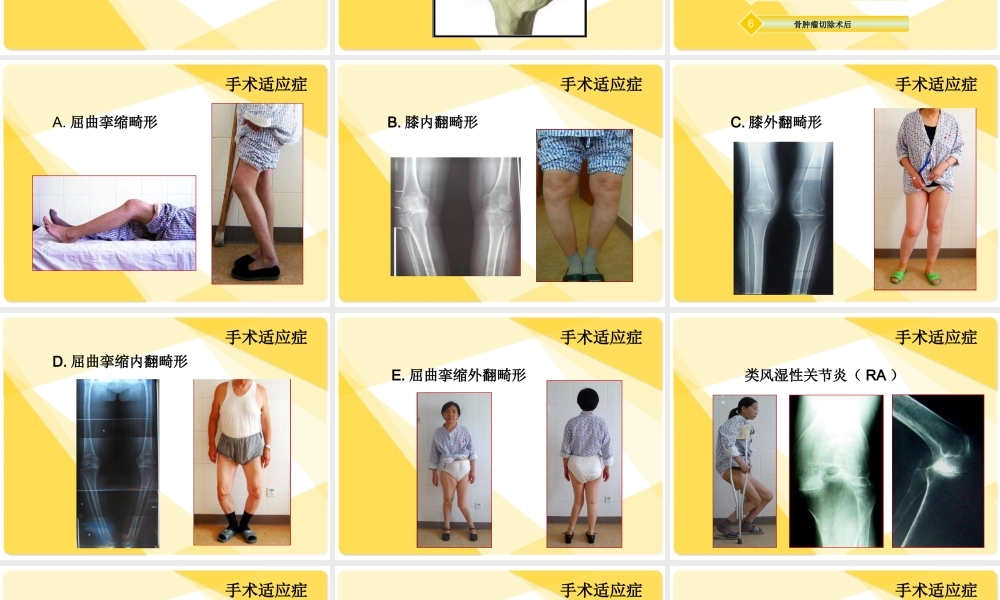 全膝关节置换术后康复.ppt