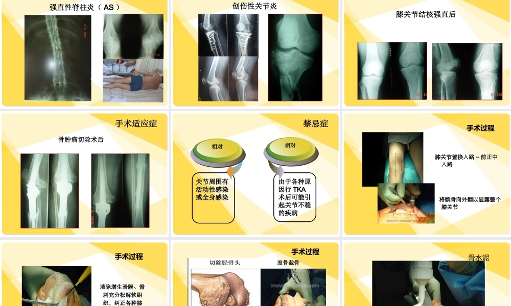 全膝关节置换术后康复.ppt