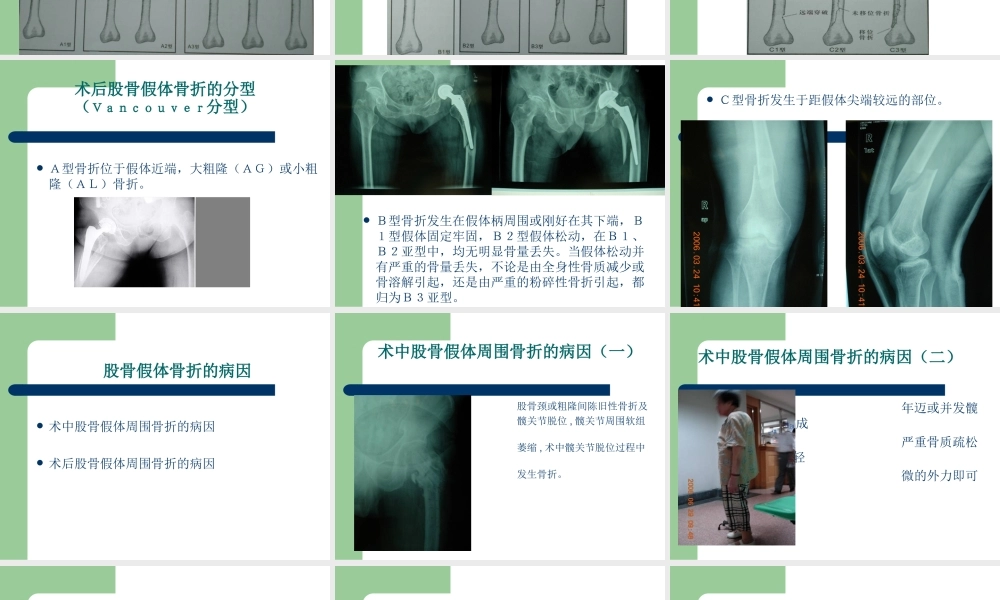 假体周围骨折概况.ppt