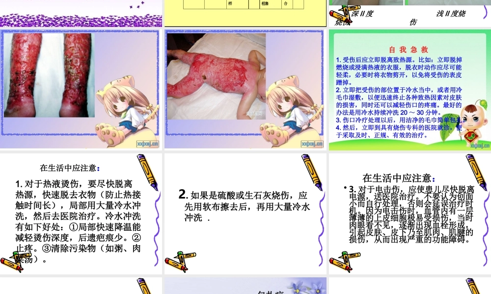 儿童烧伤的健康指导.ppt