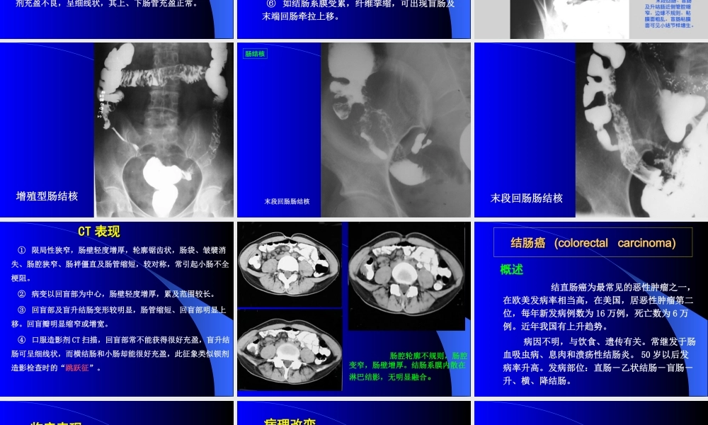 《肠结核》PPT件.ppt