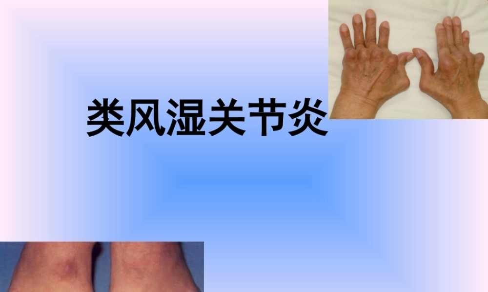 中西结合7年制教材(大量图片)类风湿性关节炎.ppt