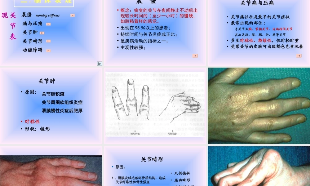 中西结合7年制教材(大量图片)类风湿性关节炎.ppt