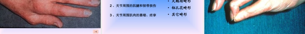 中西结合7年制教材(大量图片)类风湿性关节炎.ppt
