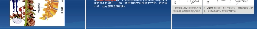 腰椎间盘突出症-ppt.ppt