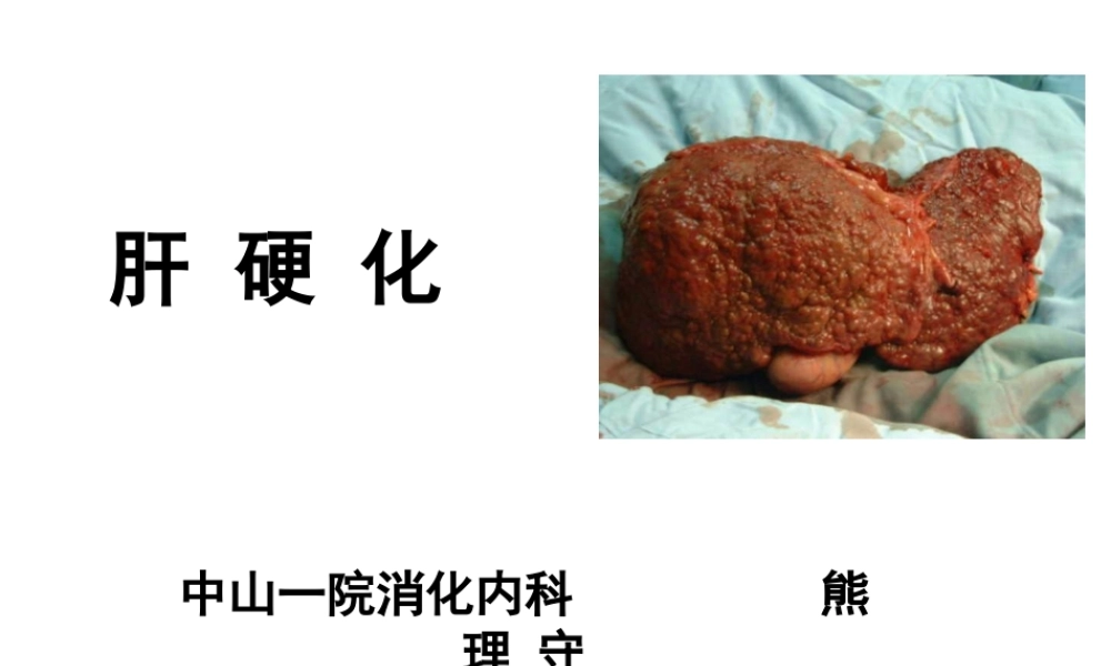 中山肝硬化概述.ppt
