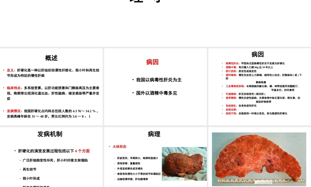 中山肝硬化概述.ppt