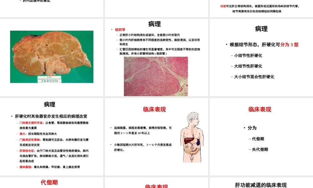 中山肝硬化概述.ppt