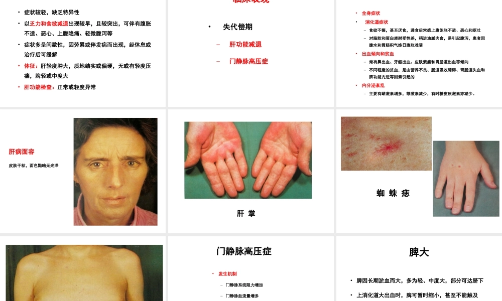 中山肝硬化概述.ppt