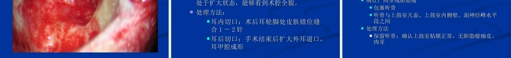 中耳炎病灶清除并一期鼓室成形术.ppt