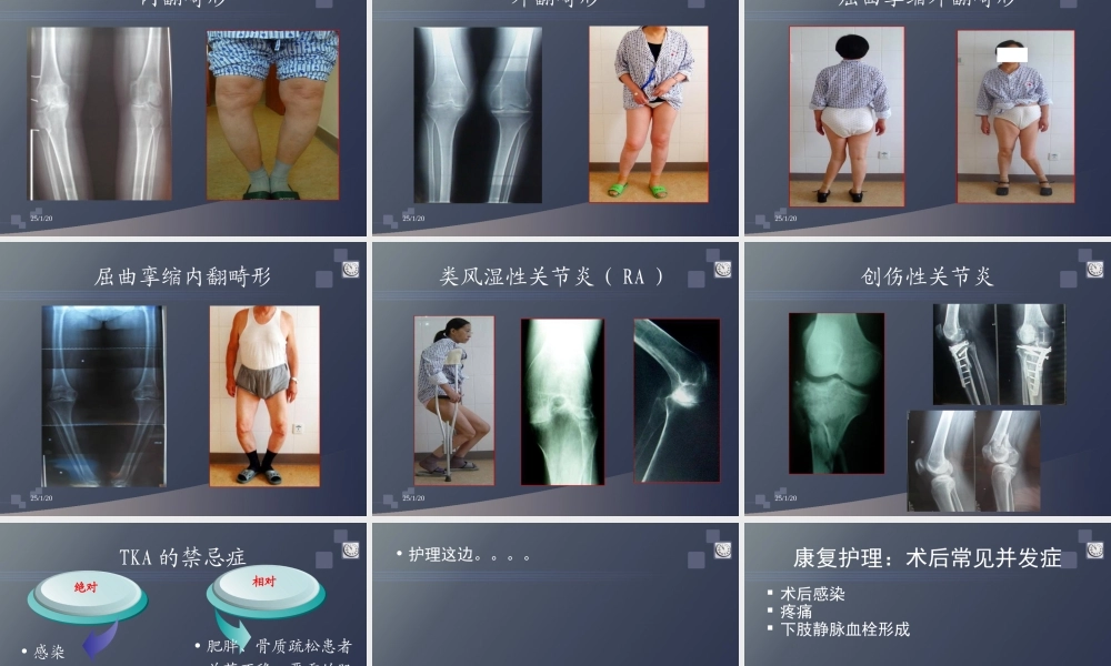 全膝关节置换术后的康复.ppt