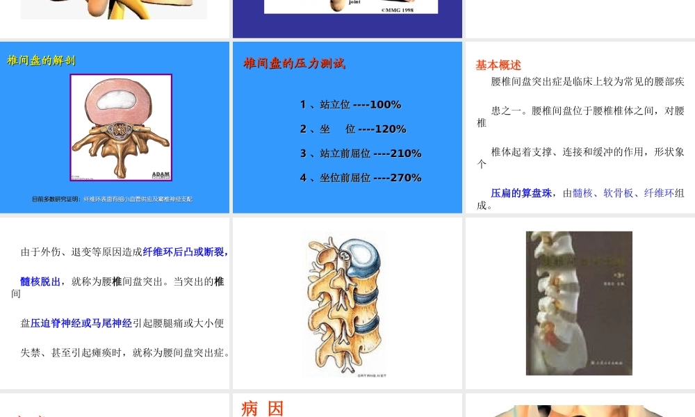 腰椎间盘突出症123(1)素材.ppt