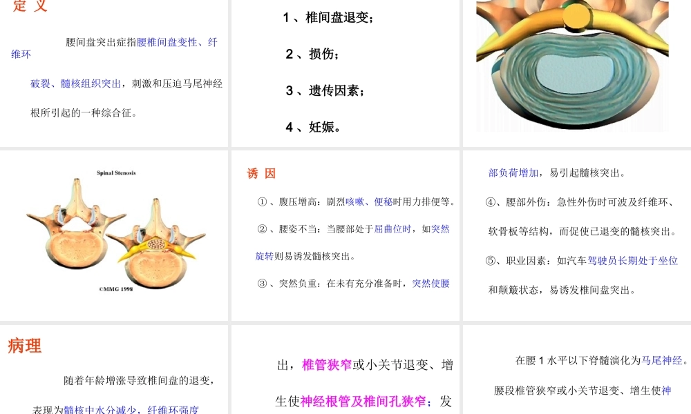 腰椎间盘突出症123(1)素材.ppt