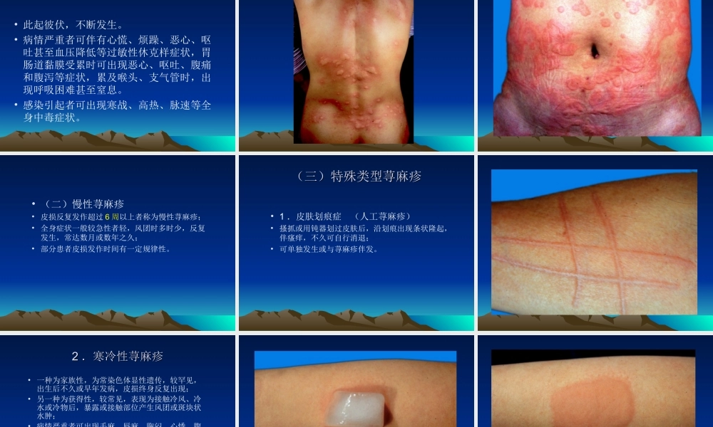 荨麻疹类皮肤病介绍.ppt