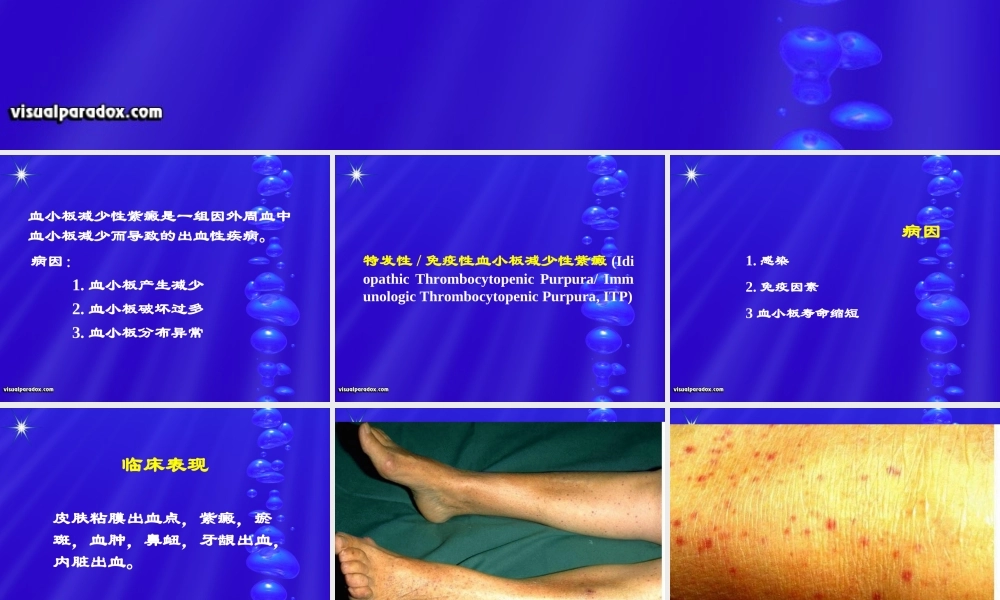 血小板减少性紫癜1.ppt