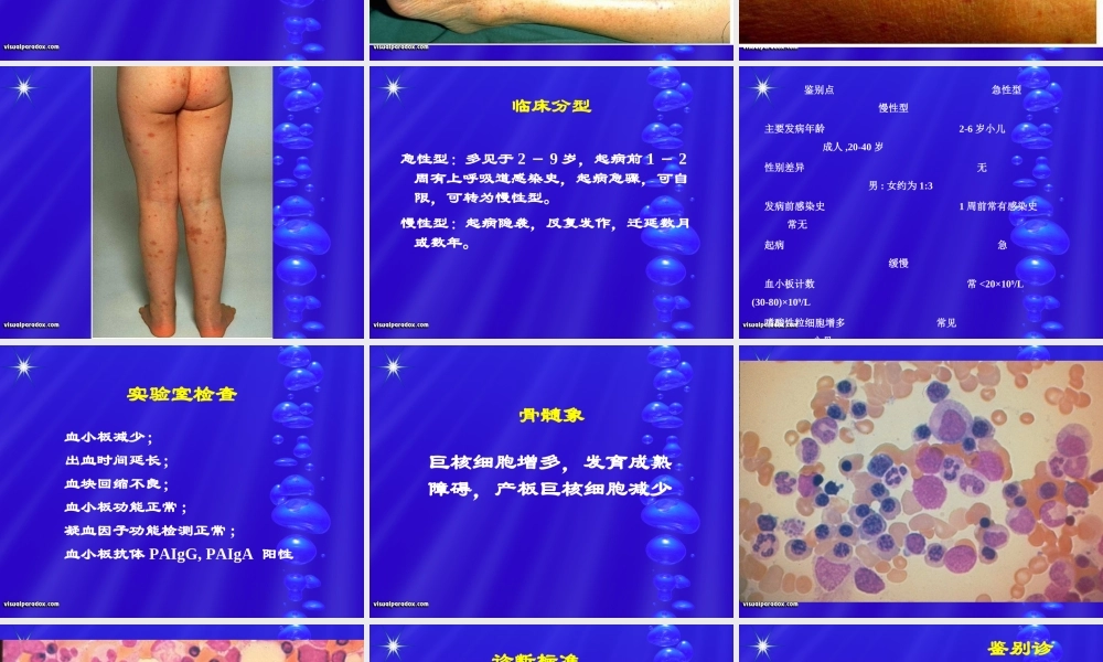 血小板减少性紫癜1.ppt