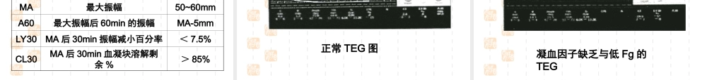 血栓弹力图.ppt