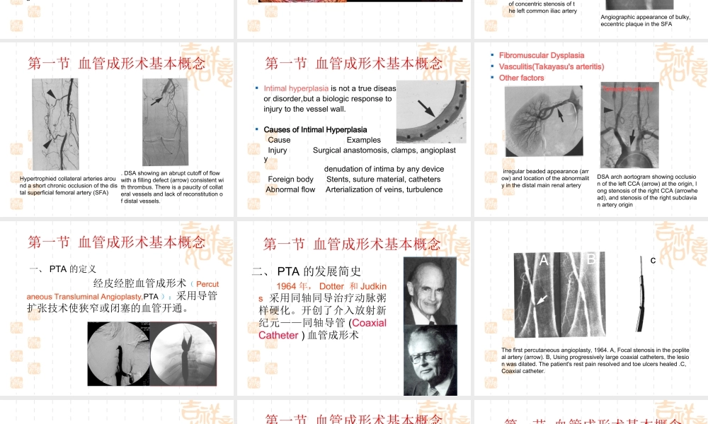 血管成形术及支架植入术.ppt