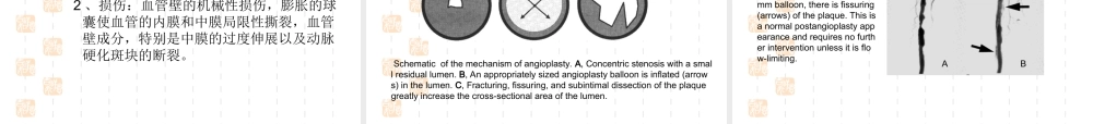 血管成形术及支架植入术.ppt
